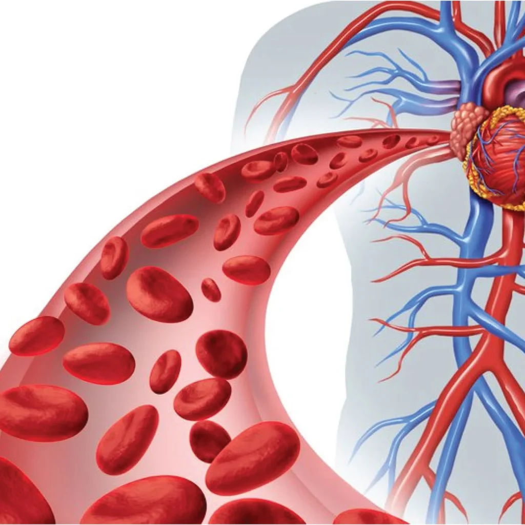 tăng áp lực tĩnh mạch cửa