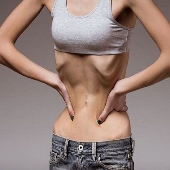 hội chứng nuôi ăn lại