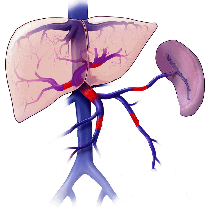 Tăng áp lực tĩnh mạch cửa ở trẻ em