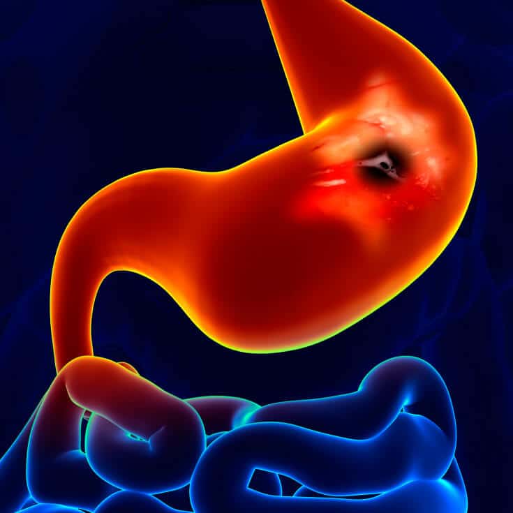 viêm loét dạ dày tá tràng ở trẻ em