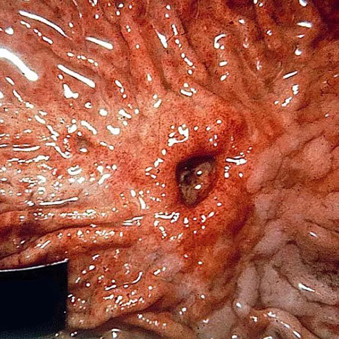 điều trị viêm loét dạ dày tá tràng ở trẻ em