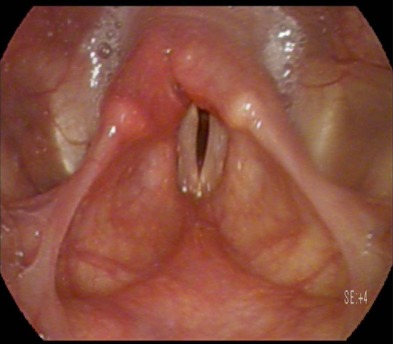 Hiểu đúng về khó thở thanh quản ở trẻ em