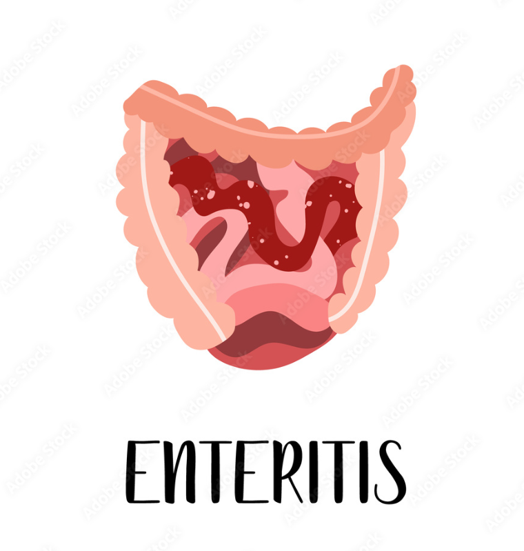 viêm ruột hoại tử ở trẻ sơ sinh