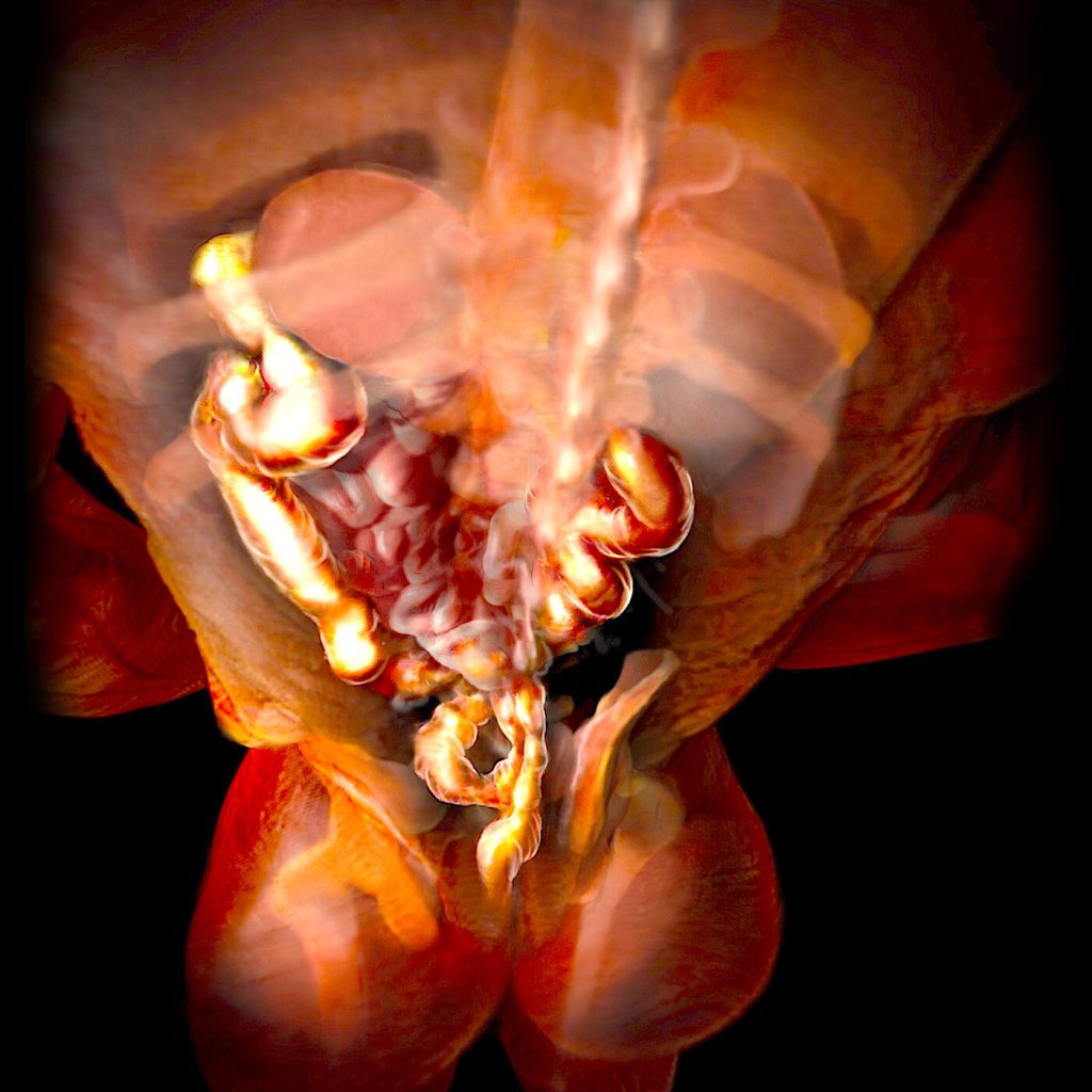 viêm ruột hoại tử ở trẻ sơ sinh